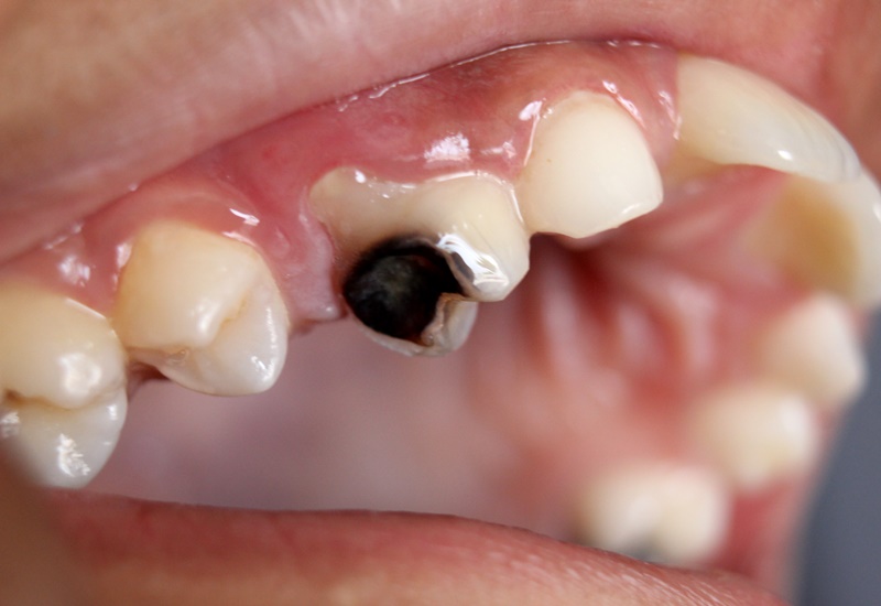 Sâu răng là tình trạng phổ biến khiến răng bạn bị ê buốt