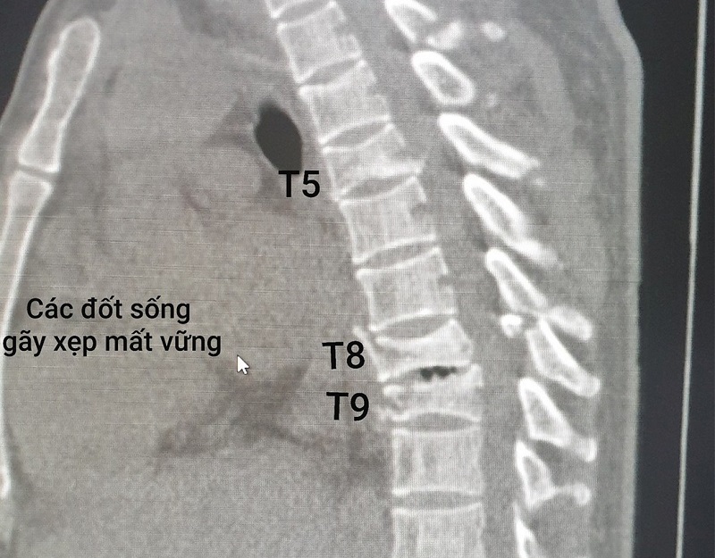 Hình ảnh chụp CT cắt lớp cho thấy bệnh nhân bị gãy nén đốt sống