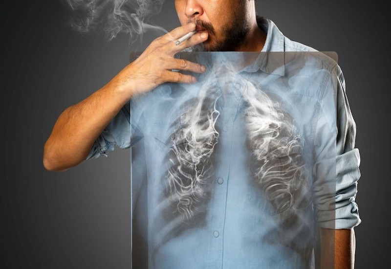 Thuốc lá là nguyên nhân hàng đầu gây ung thư phổi