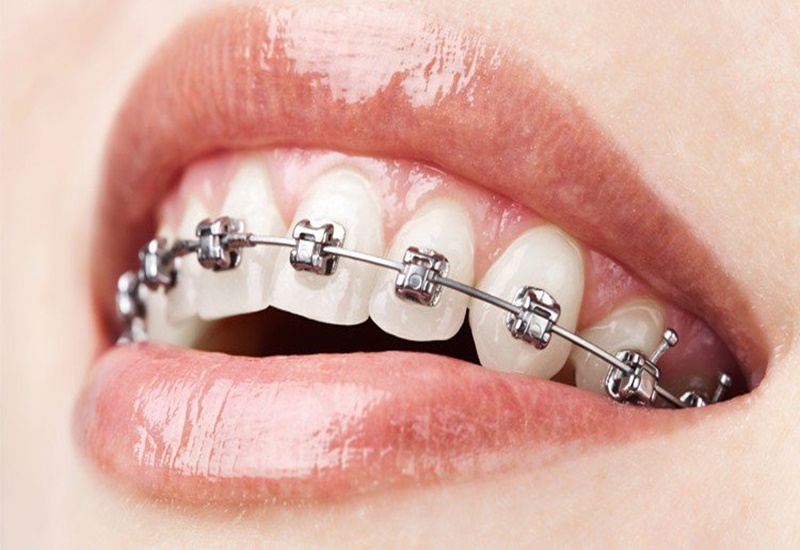 Vì sao niềng răng bằng mắc cài kim loại được ưa chuộng? | Medlatec