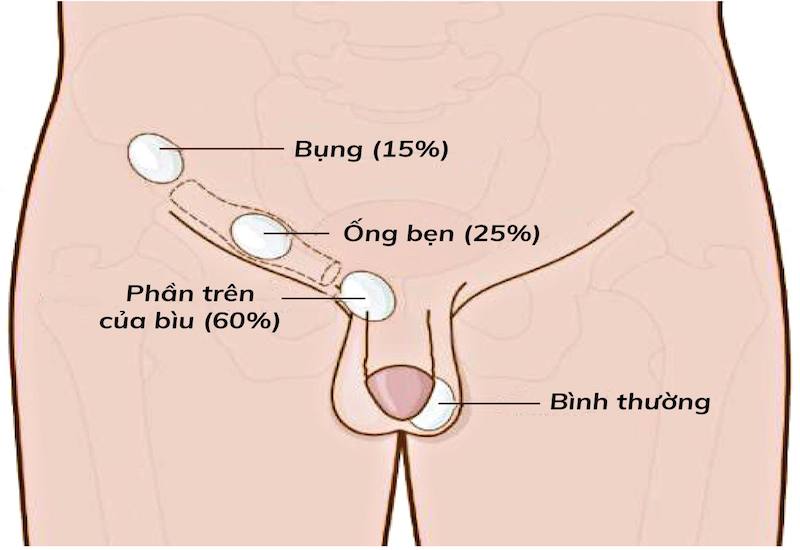 Bao nhiêu tuần thì tinh hoàn xuống bìu? Đây là con đường di chuyển của tinh hoàn 