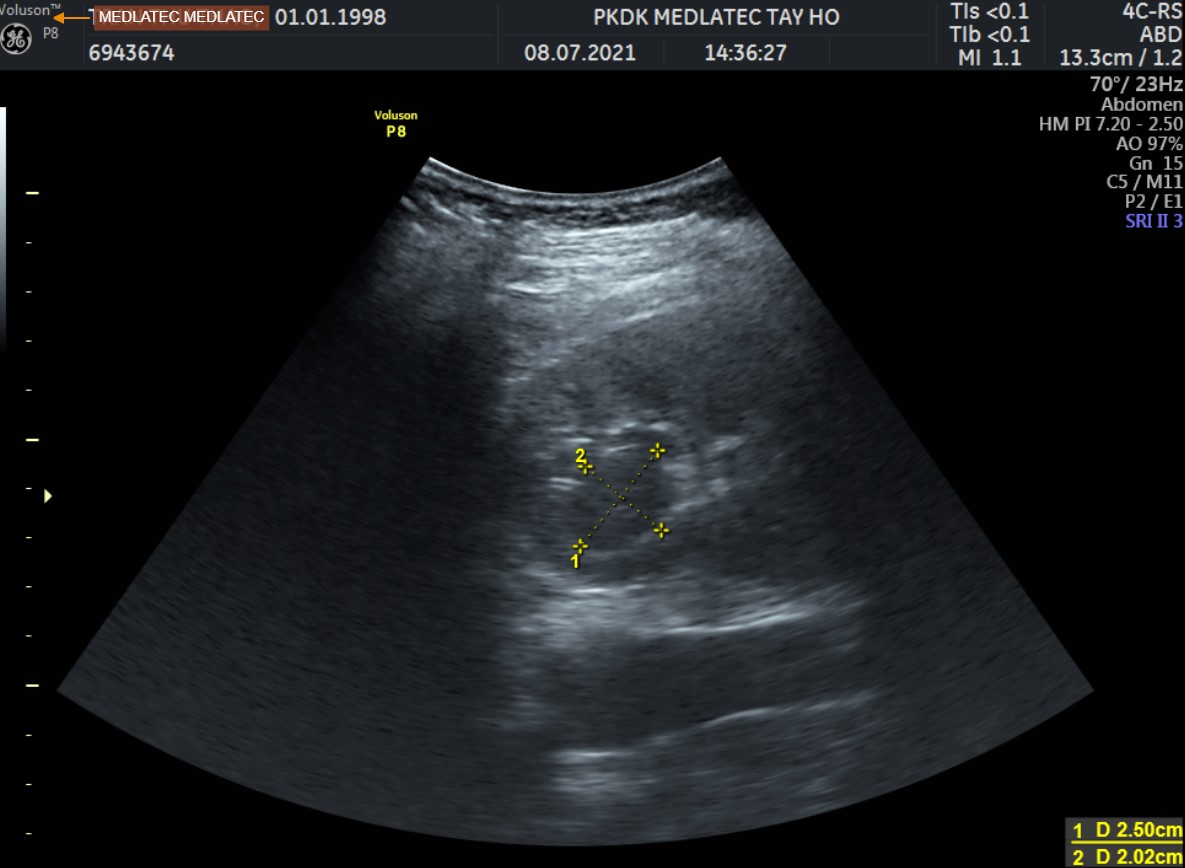 6. Những Lưu Ý Khi Thực Hiện Siêu Âm Bệnh Lý Thận