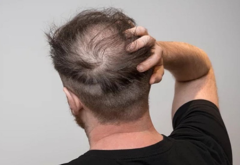 Rụng tóc nhiều là triệu chứng của bệnh lý gì? | Medlatec