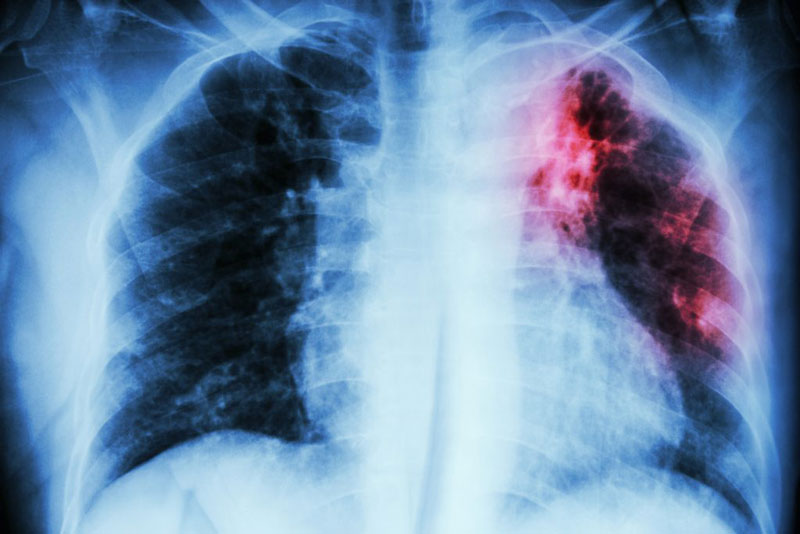 Bệnh nhân lao phổi nên điều trị ngay khi phát hiện bệnh