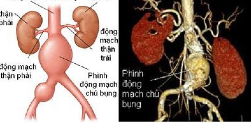 Bụng Đập Như Nhịp Tim: Nguyên Nhân, Triệu Chứng Và Giải Pháp