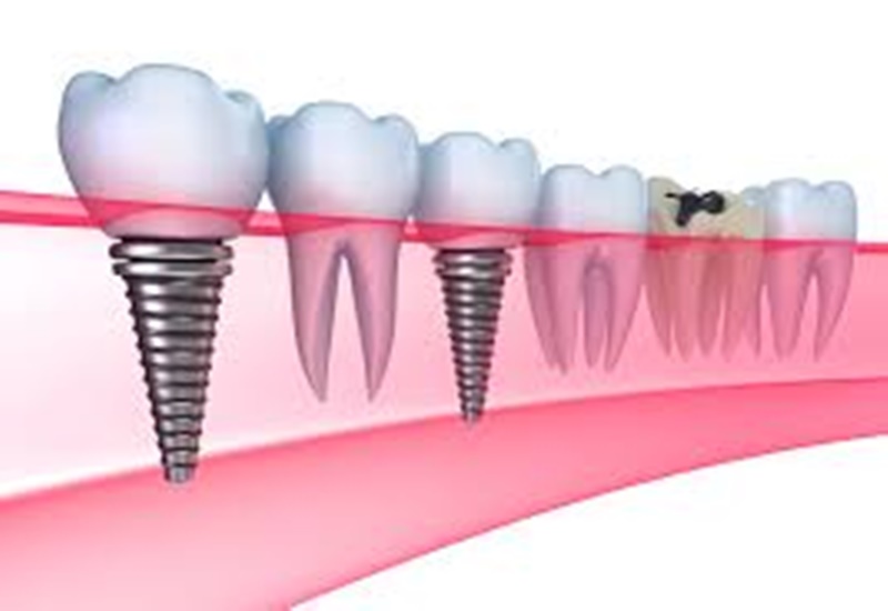 Cấy ghép Implant là cách dùng chân răng giả để cấy ghép vào xương hàm thay cho chân răng thật