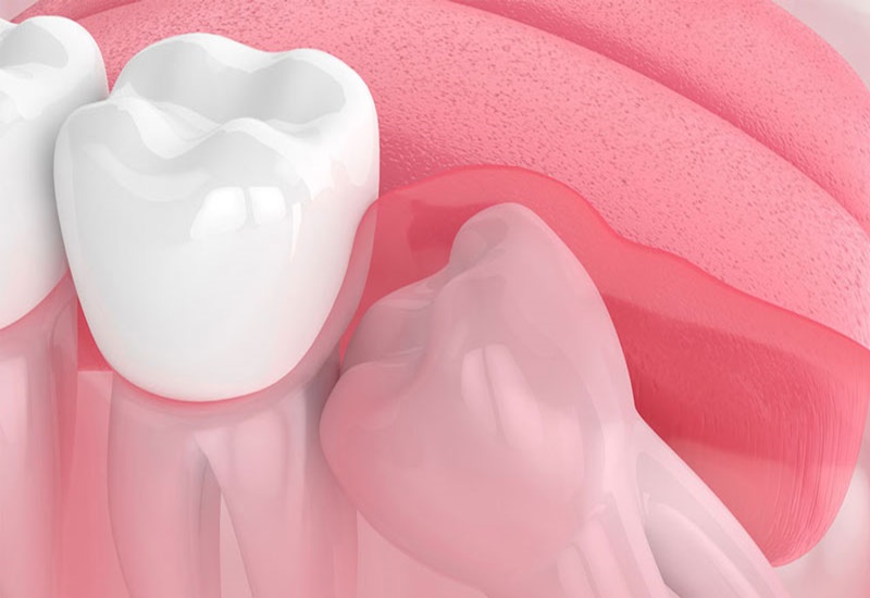 Khi nào nên nhổ răng khôn? Nên nhổ ở đâu? | Medlatec