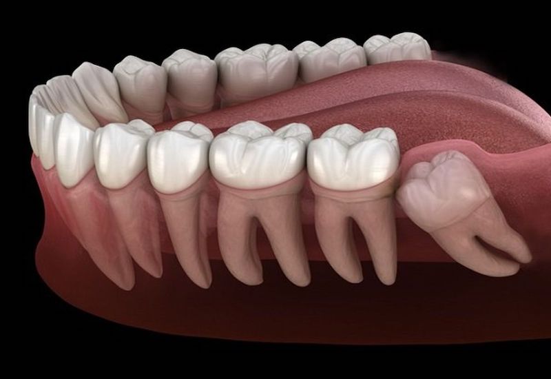 Hình ảnh một chiếc răng khôn mọc lệch