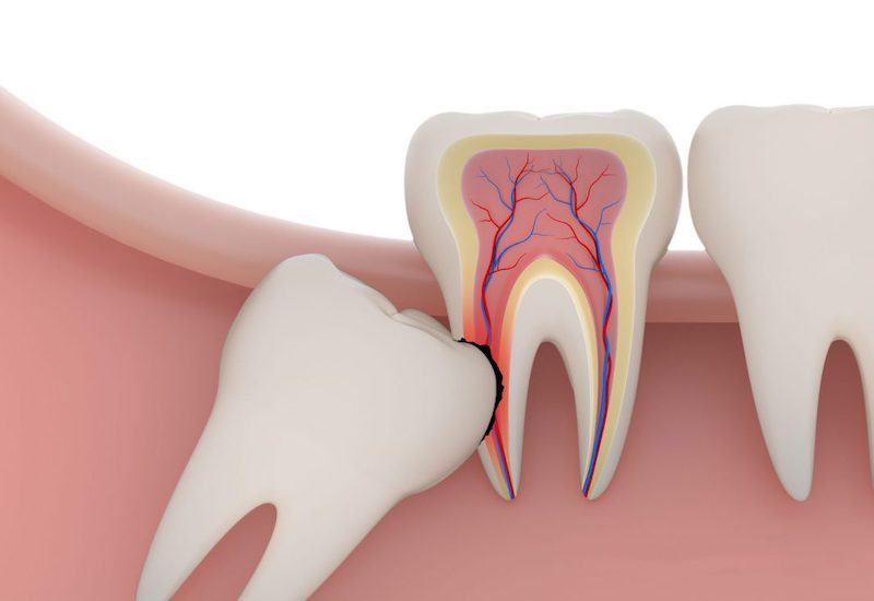 Dù tên là răng khôn nhưng lại luôn mọc rất trái ngang