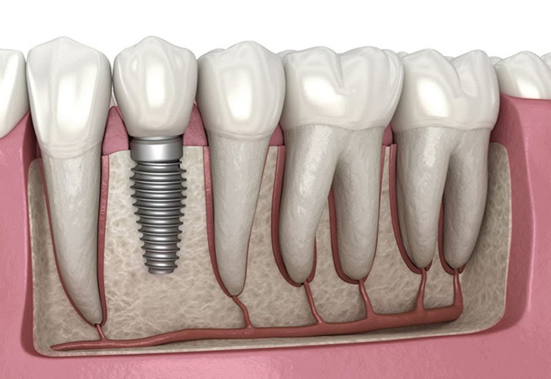 Cấy ghép Implant có nhiều ưu điểm