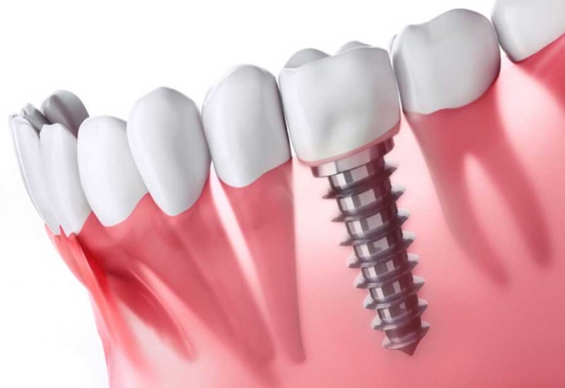 Mỗi loại trụ Implant sẽ có mức giá khác nhau