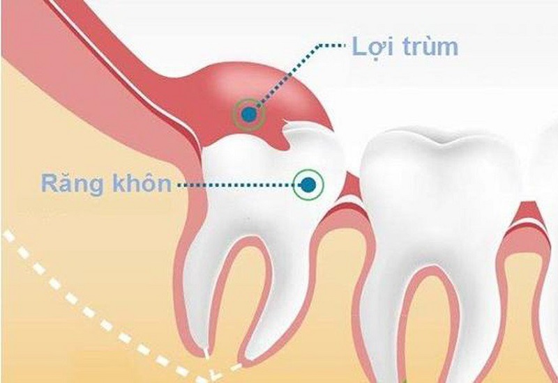 Viêm lợi trùm là tình trạng dễ gặp trong quá trình răng khôn mọc
