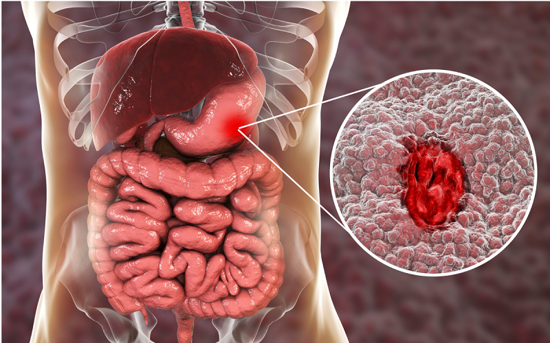 Ung thư dạ dày xảy ra khi có sự phát triển bất thường và không kiểm soát được của các tế bào trong dạ dày