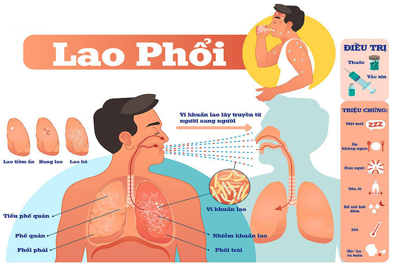 Bị lao phổi có nguy hiểm không? Tìm hiểu mức độ nguy hiểm và giải pháp điều trị hiệu quả