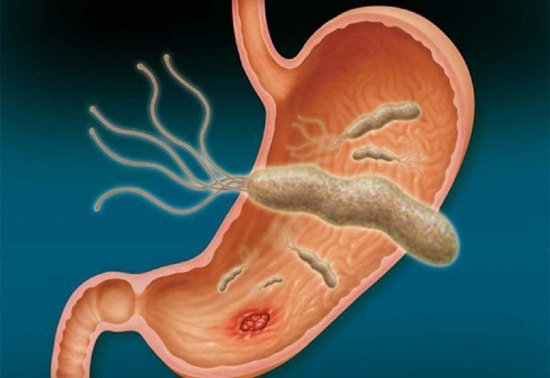 Helicobacter pylori là một trong những nguyên nhân gây viêm niêm mạc dạ dày