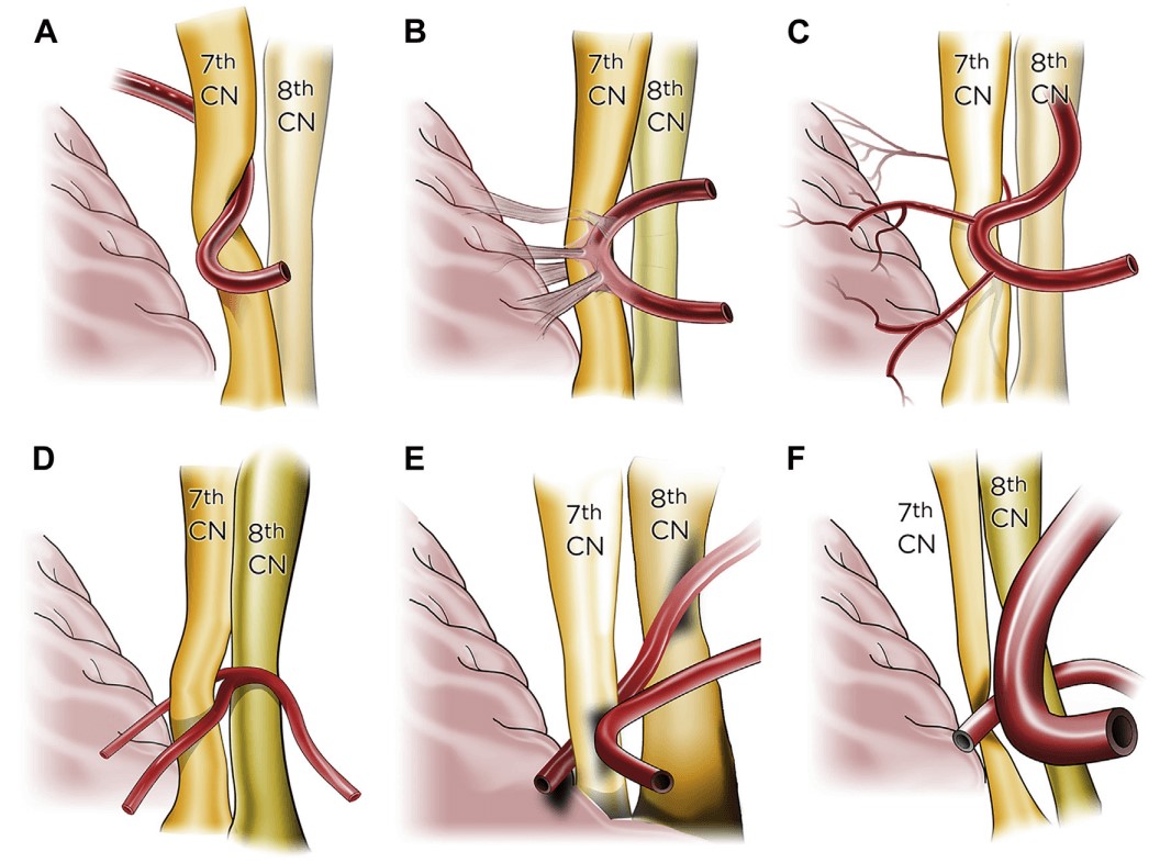 Hình ảnh minh họa một số mạch máu chèn vào dây thần kinh số  VII và VIII