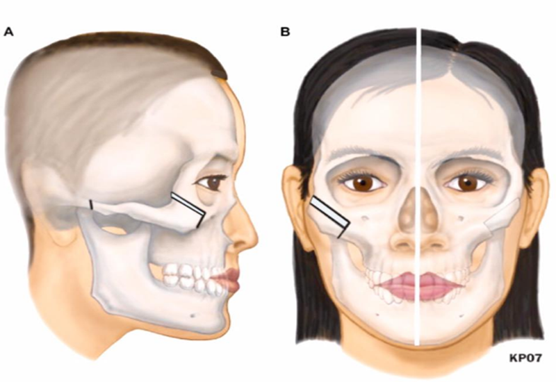 Xương gò má bị gãy gây ảnh hưởng đến thẩm mỹ khuôn mặt