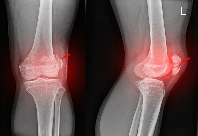 Trật khớp bánh chè – đùi là nguyên nhân phổ biến gây hội chứng Patellofemoral