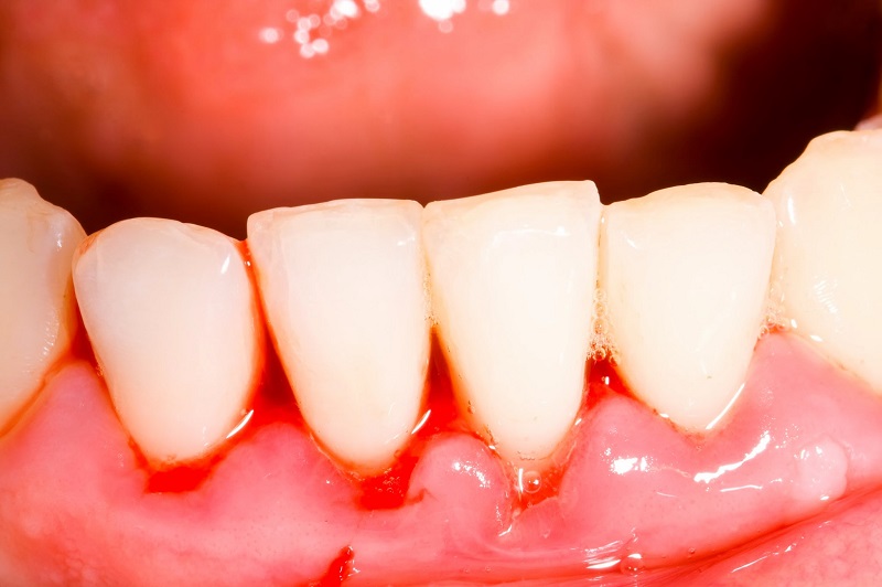 Bệnh nha chu gây viêm nhiễm mô xung quanh răng