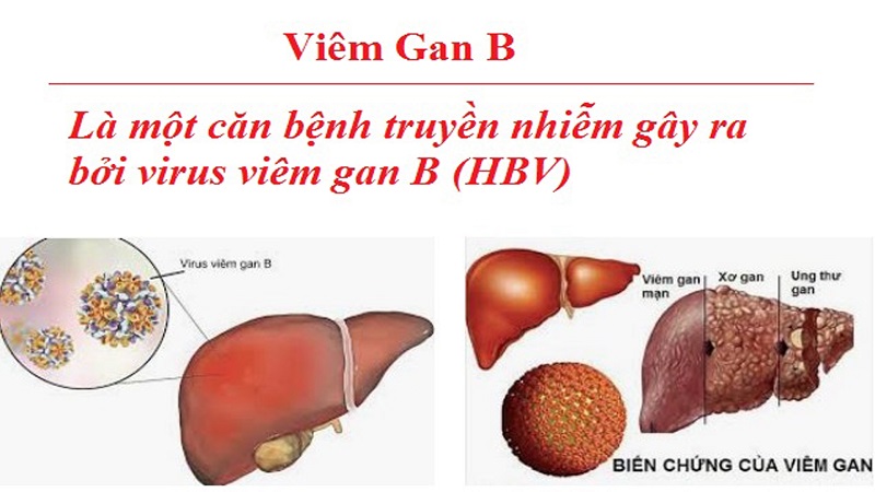 Viêm gan B có thể tiến triển mạn tính và đe dọa sự sống