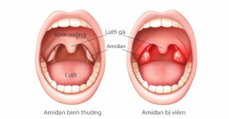 Không ho nhưng có đờm tích tụ ở cổ họng có thể là do bị viêm amidan gây ra