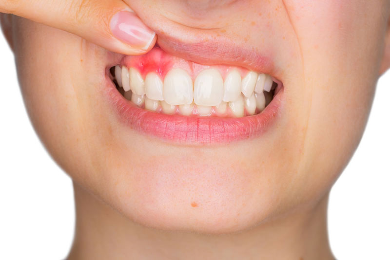 Nhựa mù u kết hợp với bột đại hoàng hỗ trợ điều trị viêm loét răng 