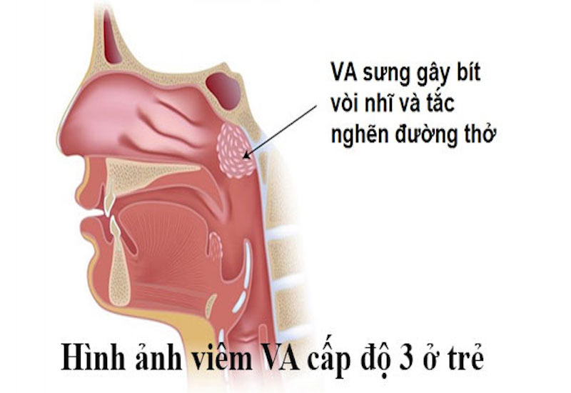 Viêm VA quá phát ở trẻ thường gây ra những triệu chứng rất khó chịu