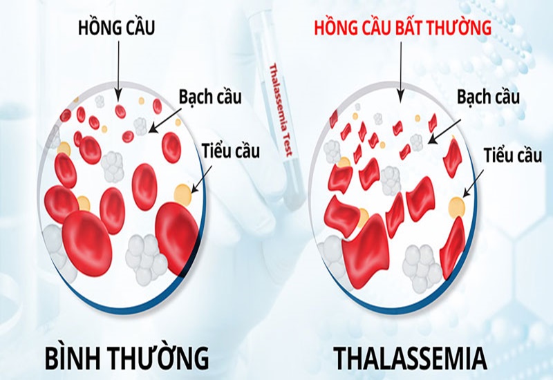 Bệnh tan máu bẩm sinh có tính di truyền