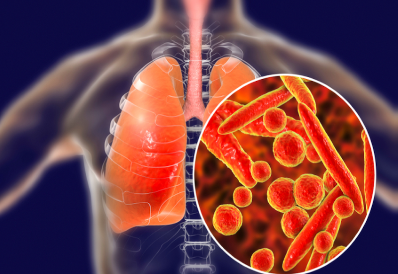  Lao phổi là một bệnh lý truyền nhiễm có tỷ lệ mắc khá cao ở Việt Nam