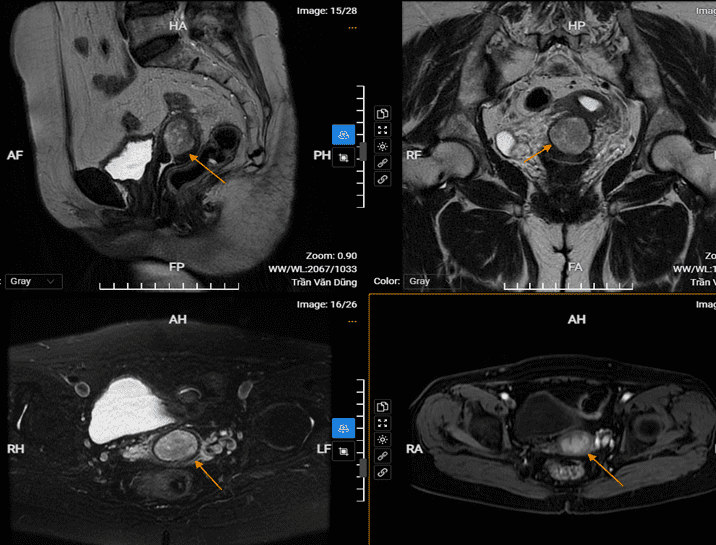 chụp mri tử cung