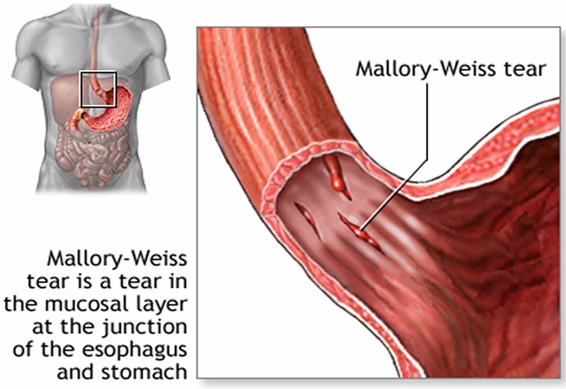 Hội chứng Mallory weiss là vấn đề thường gặp về đường tiêu hóa