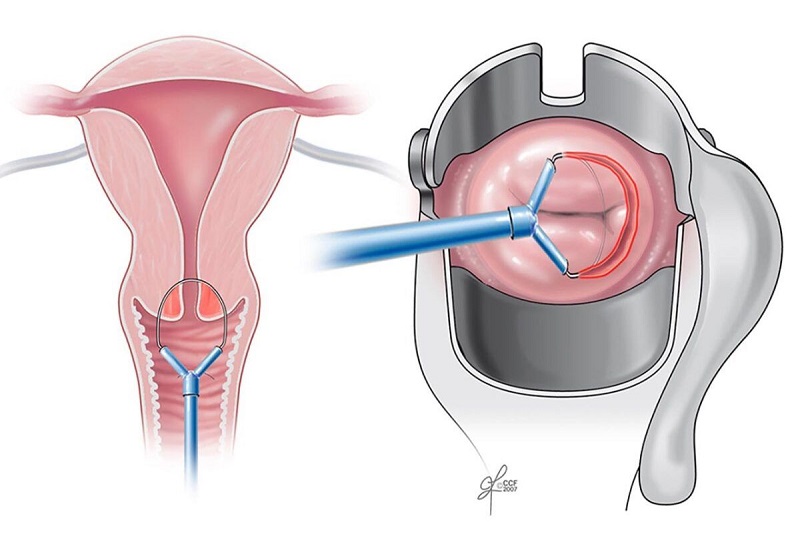 Ung thư cổ tử cung là một căn bệnh rất nguy hiểm