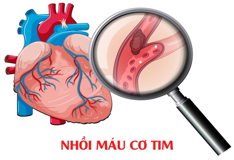 Phát hiện nhồi máu cơ tim nhờ kết quả điện tâm đồ