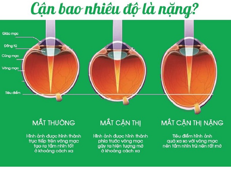 Mô phỏng về mức độ cận thị