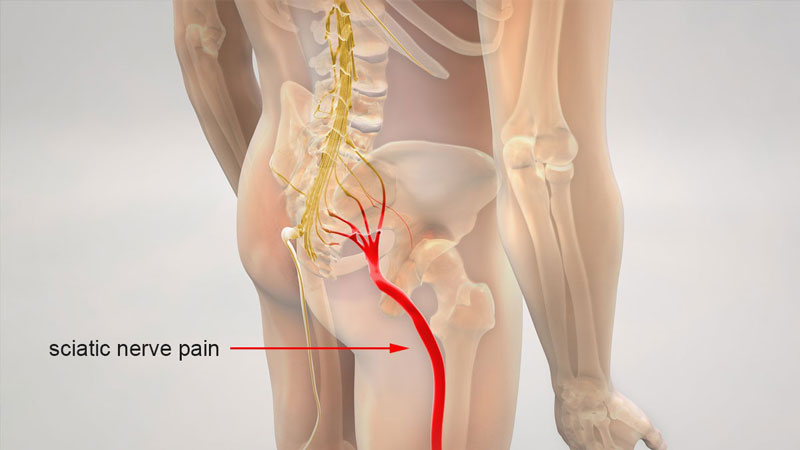 Đau dây thần kinh tọa gồm hai dạng cấp và mạn tính