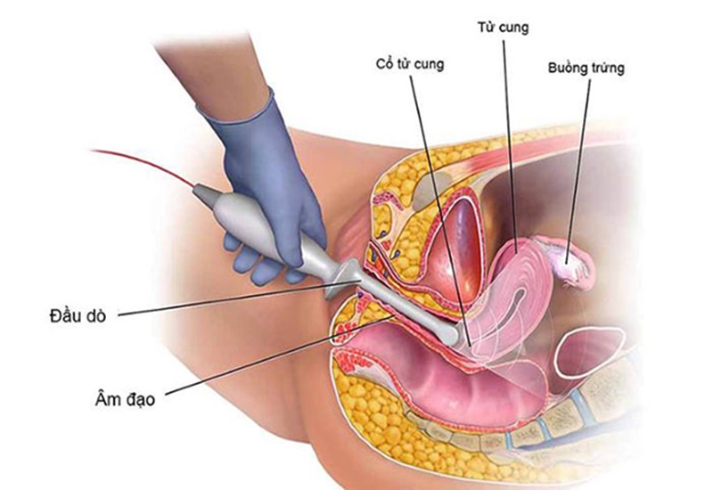 Nội soi cổ tử cung để xác định tổn thương tại cơ quan này