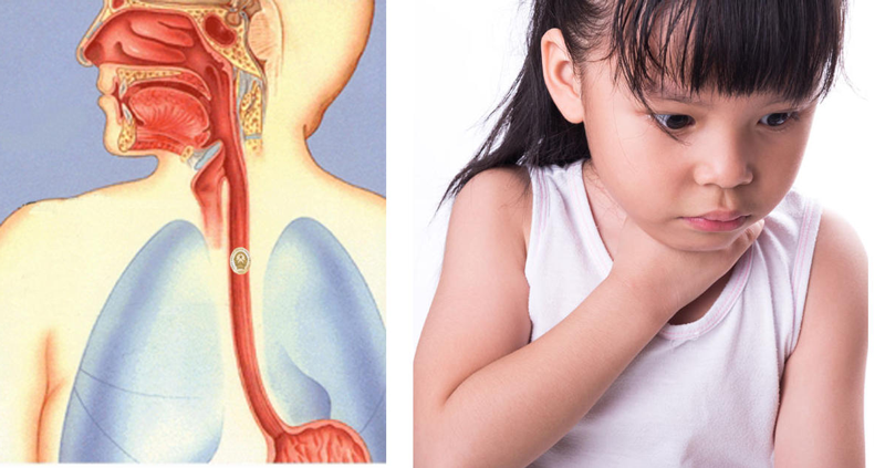 Mắc dị vật họng có thể gây nhiều biến chứng, nhất là ở trẻ em