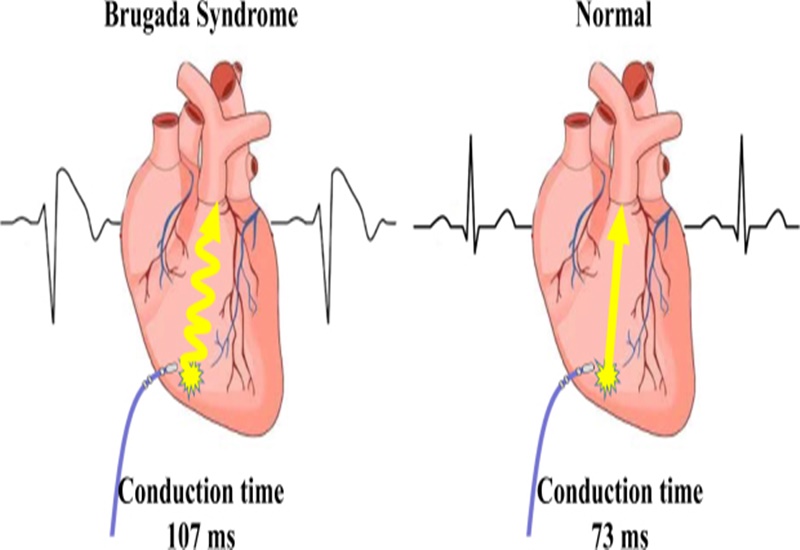 Hội chứng Brugada hiếm gặp với tỷ lệ mắc bệnh là 5/ 10.000 người