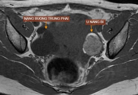 MRI tiểu khung có tiêm trong chẩn đoán u nang bì buồng trứng