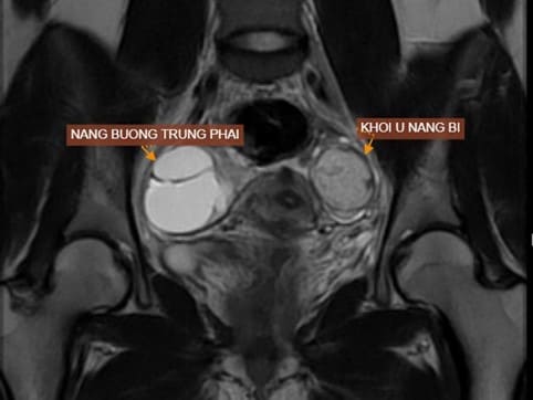 MRI tiểu khung có tiêm trong chẩn đoán u nang bì buồng trứng