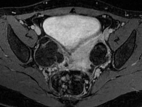 MRI tiểu khung có tiêm trong chẩn đoán u nang bì buồng trứng