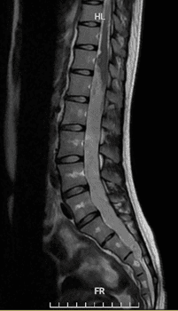 Chụp MRI trong chẩn đoán u tủy sống