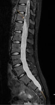 Chụp MRI trong chẩn đoán u tủy sống