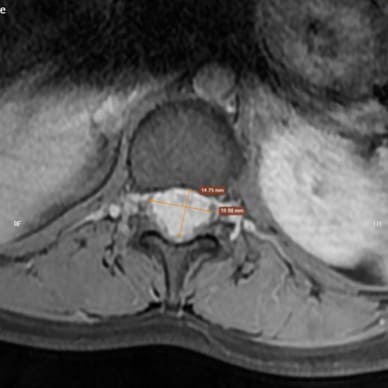 Chụp MRI trong chẩn đoán u tủy sống