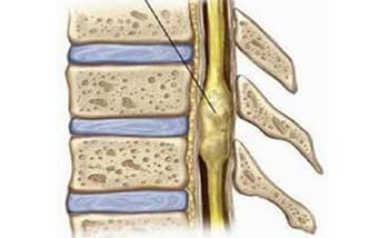 Chụp MRI trong chẩn đoán u tủy sống