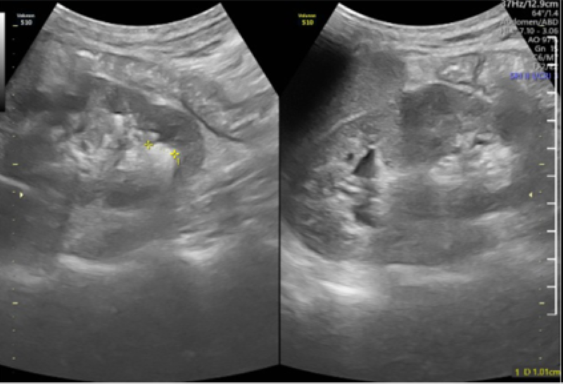 Hình ảnh siêu âm cho thấy bệnh nhân có nhiều sỏi thận hai bên 
