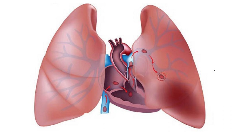 Hình thành cục máu đông dẫn đến thuyên tắc phổi