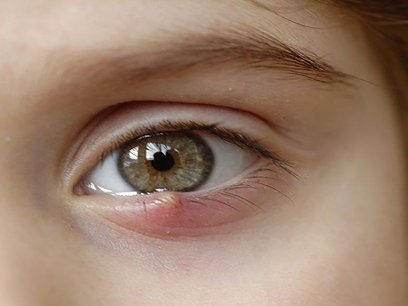 Có nhiều nguyên nhân và cách chữa lẹo mắt tại nhà