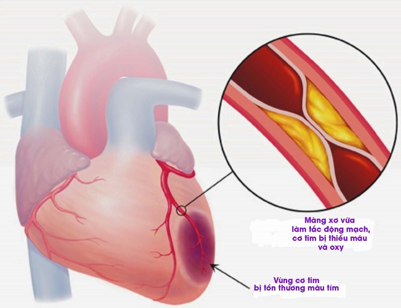 Biến chứng của bệnh cao huyết áp có thể dẫn đến nhồi máu cơ tim