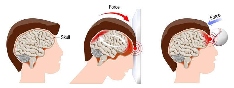 Chấn động não là tình trạng não bị tổn thương cho va đập mạnh